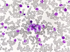 Przewlekła białaczka szpikowa – objawy, diagnostyka, leczenie, rokowania